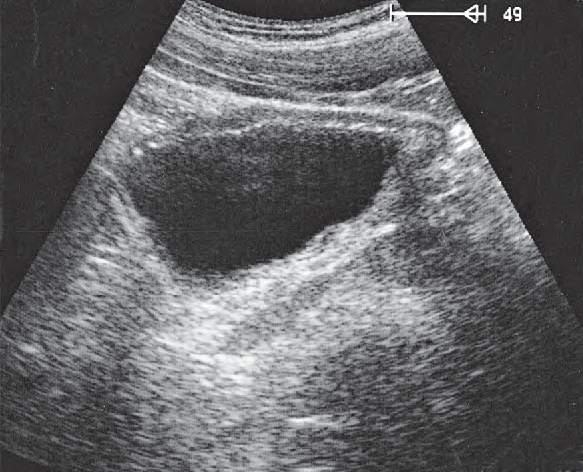Bladder ultrasound image, Bladder, ureteral orifice, prostate, rectum