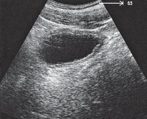 Bladder ultrasound image, Bladder, rectum