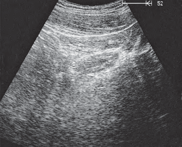 Bladder ultrasound image, Bladder, bowel
