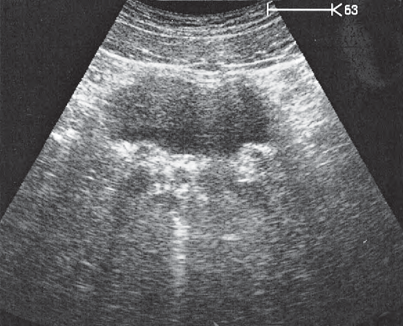 Opening of Ureter Ultrasound Anatomy