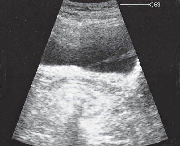 Bladder ultrasound image, Bladder, inflow of urine
