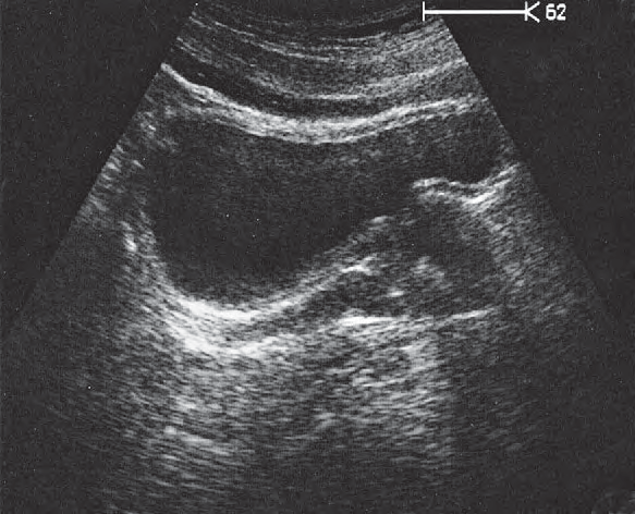 Bladder ultrasound image, Prostate, rectum, bladder
