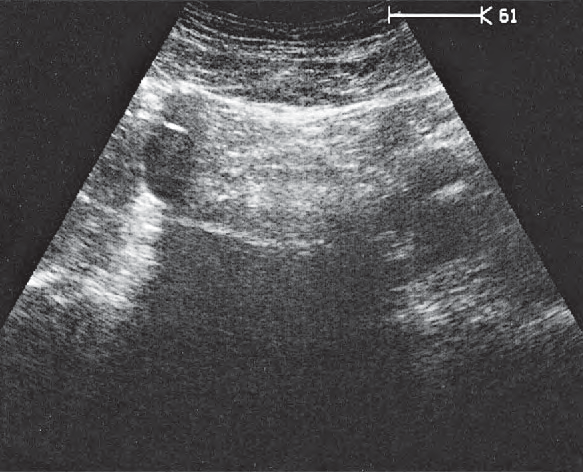 Spinal column ultrasound image, Iliac vessels