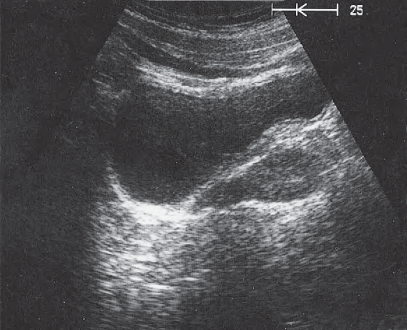 Bladder ultrasound image, Prostate, rectum, bladder