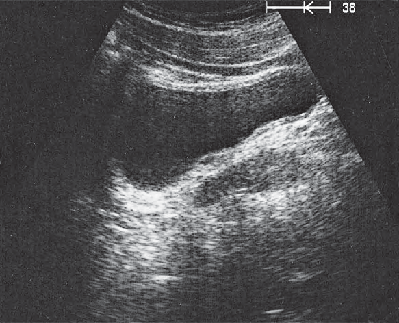 Seminal Vesicle Ultrasound Anatomy
