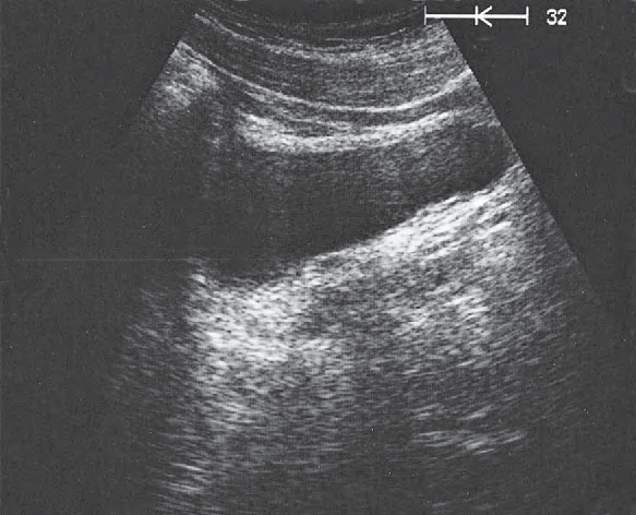 Bladder ultrasound image, Prostate, seminal vesicles