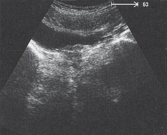 Urethra Ultrasound Anatomy