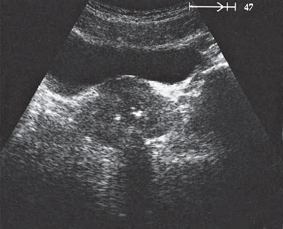 Bladder ultrasound image, Prostate, urethra, bladder