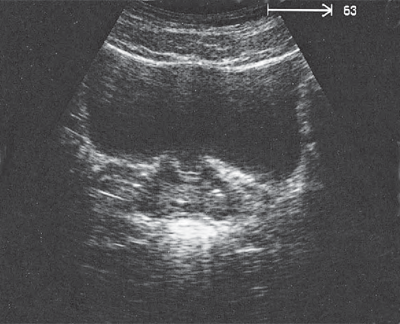 Bladder ultrasound image, Prostate, bladder