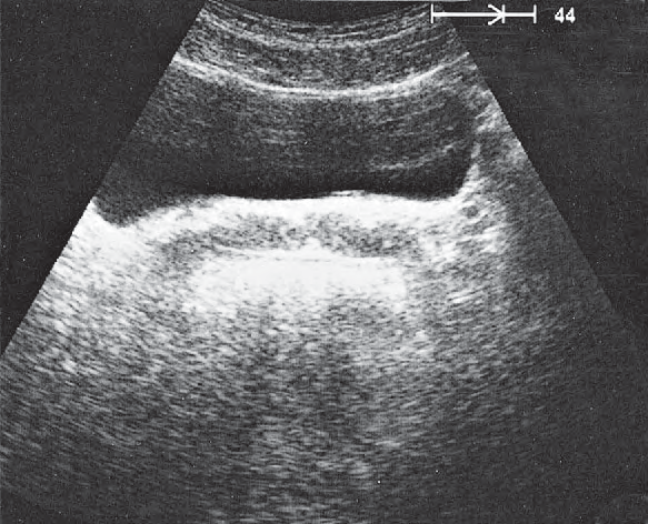 Bladder ultrasound image, Seminal vesicles, bladder