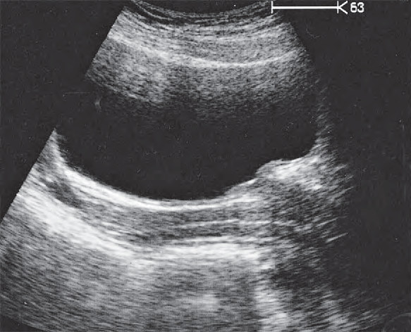 Vagina Ultrasound Anatomy