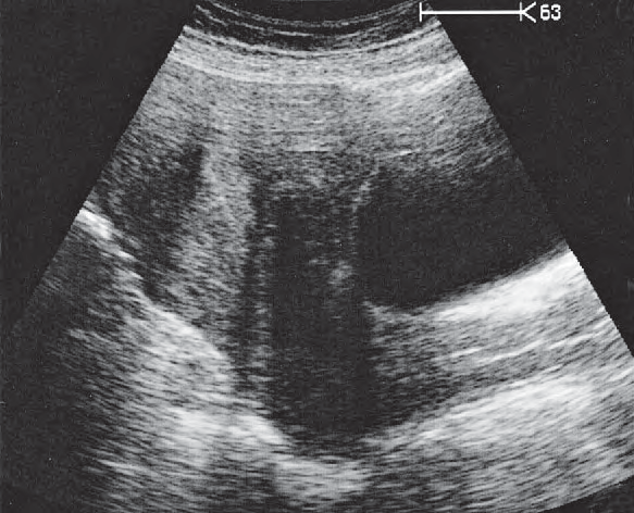 Uterus Ultrasound Anatomy