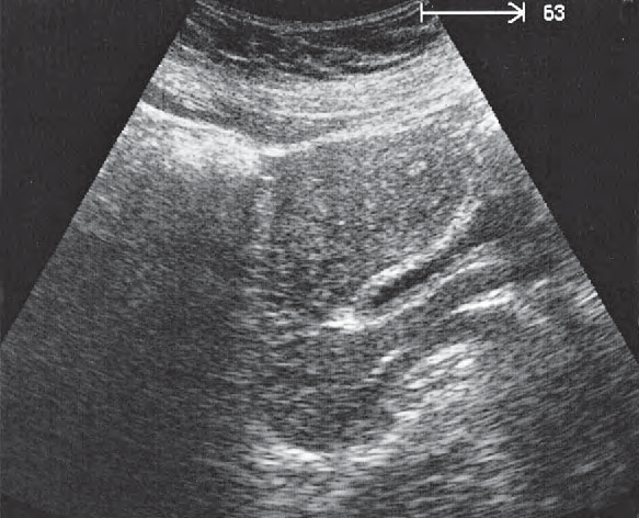 Bladder ultrasound image, Vagina, uterus, bladder