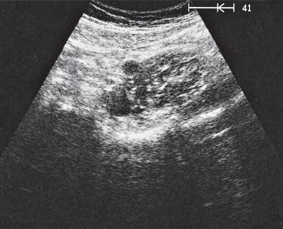 Pelvic Bone Ultrasound Anatomy