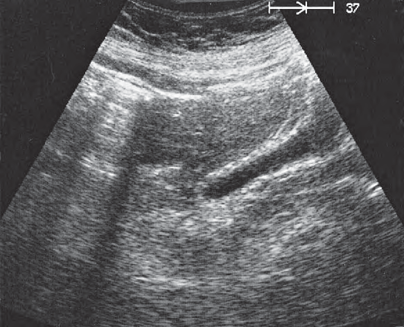 Bladder ultrasound image, Uterus, bladder