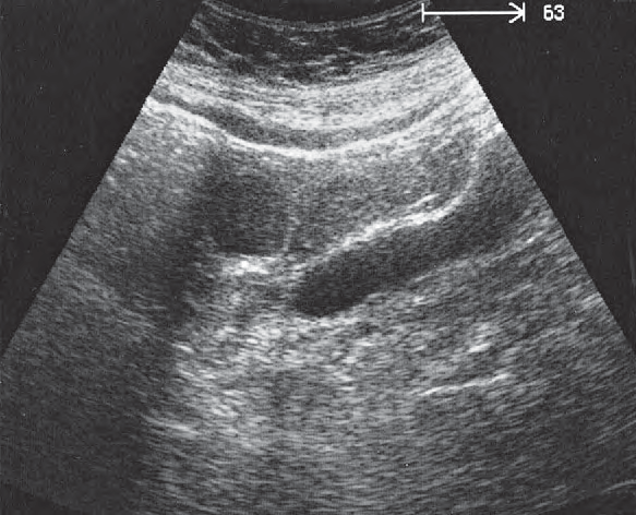 Left Ovary Ultrasound Anatomy