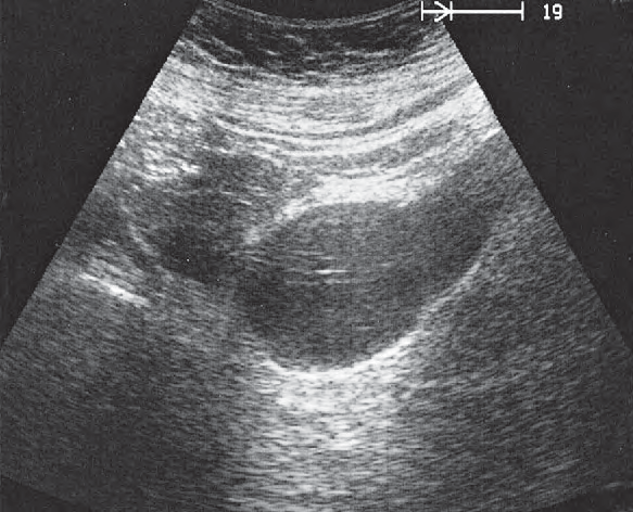 Bladder ultrasound image, Bladder, ovary