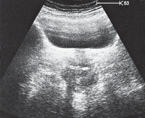 Bladder ultrasound image, Vagina, bladder, rectum