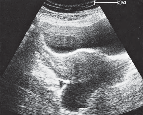 Bladder ultrasound image, Uterus, bladder, rectum
