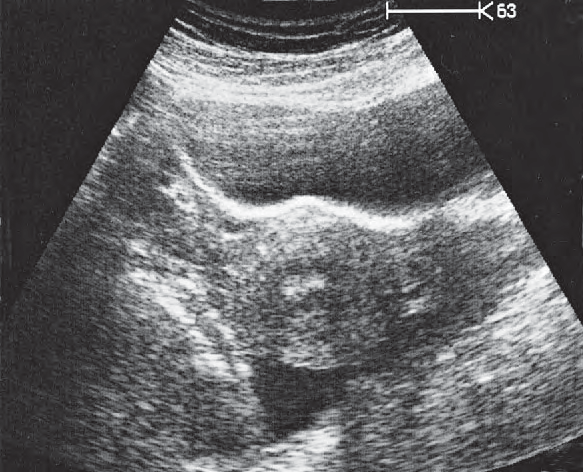 Right Ovary Ultrasound Anatomy