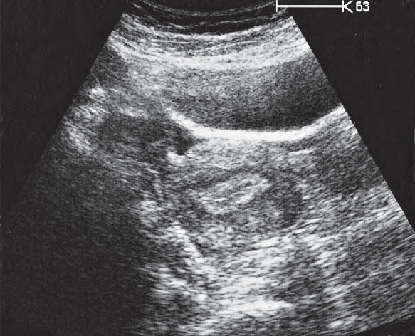 Bladder ultrasound image, Uterus, bladder, rectum, ovaries