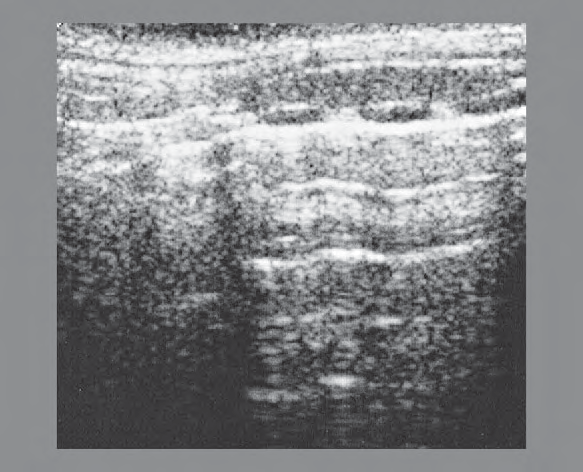 Tracheal Cartilage Ultrasound Anatomy