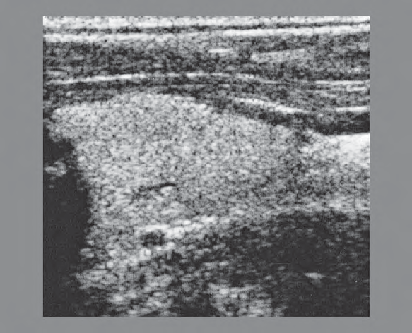 Sternothyroid Muscle Ultrasound Anatomy