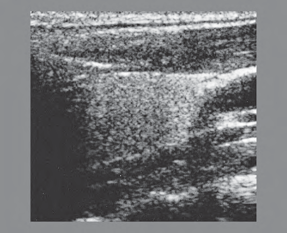 Internal Jugular Vein Ultrasound Anatomy