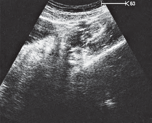 Bladder ultrasound image, Left iliac vessels