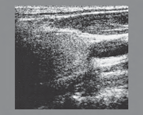 Common Carotid Artery Ultrasound Anatomy