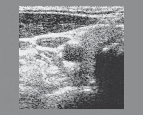 Artifact ultrasound image, Right lobe of thyroid gland, sternocleidomastoid muscle, common carotid artery, internal jugular vein