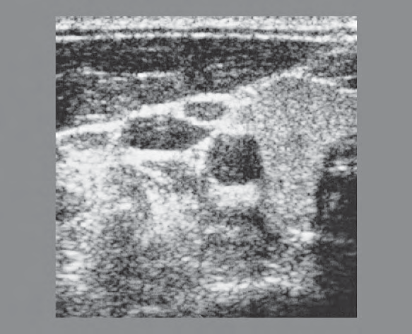 Omohyoid Muscle Ultrasound Anatomy