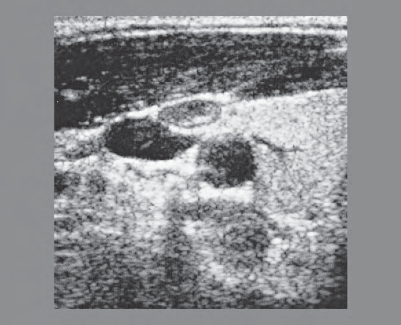 Omohyoid muscle ultrasound image, Right lobe of thyroid gland, sternocleidomastoid muscle, omohyoid muscle, sternohyoid muscle, common carotid artery, internal jugular vein