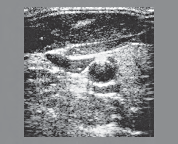 Omohyoid muscle ultrasound image, Right lobe of thyroid gland, sternocleidomastoid muscle, omohyoid muscle, sternohyoid muscle, common carotid artery, internal jugular vein