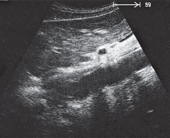 Pancreas Ultrasound Anatomy