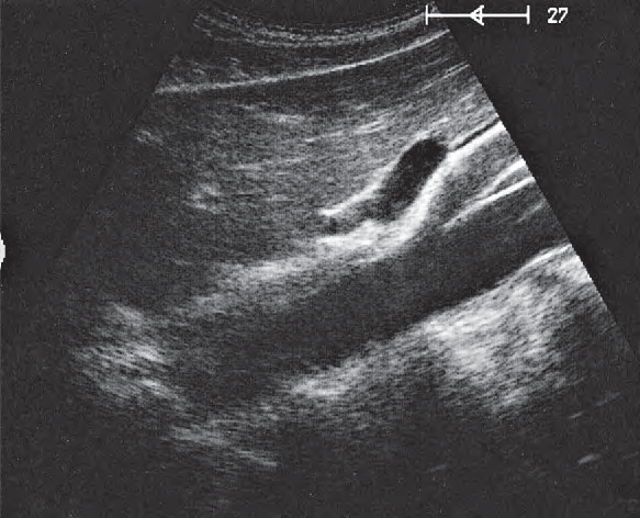 Superior mesenteric artery ultrasound image, Splenic vein and left gastric artery