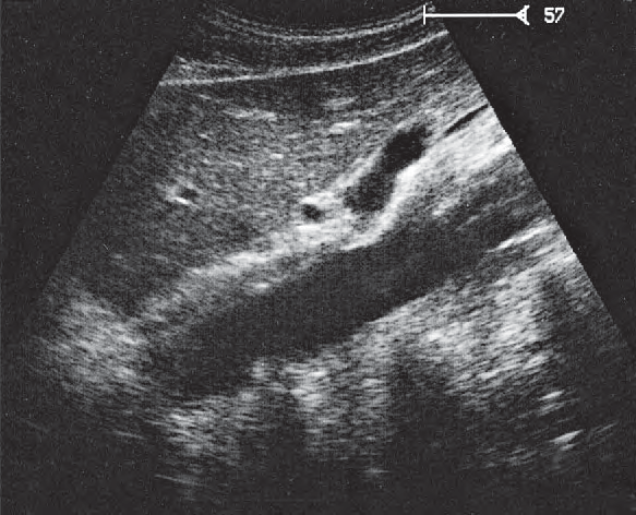 Left renal vein ultrasound image, Splenic artery and vein, celiac trunk