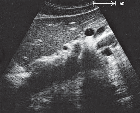 Left renal artery ultrasound image, Splenic artery and vein, celiac trunk