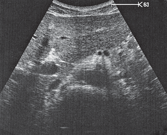 Celiac Trunk Ultrasound Anatomy
