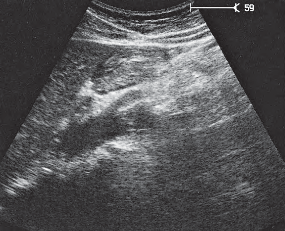 Stomach ultrasound image, Celiac trunk