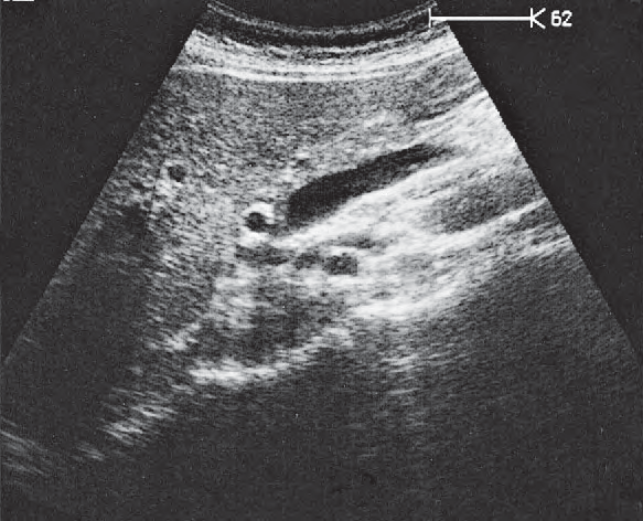 Superior Mesenteric Vein Ultrasound Anatomy