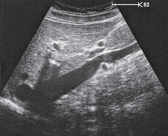 Portal Vein Ultrasound Anatomy