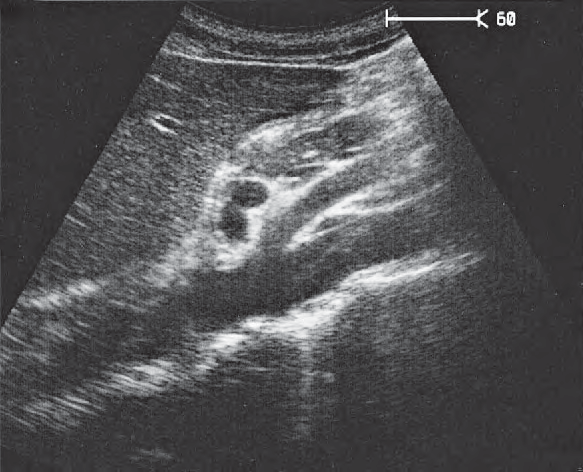 Left renal vein ultrasound image, Aorta