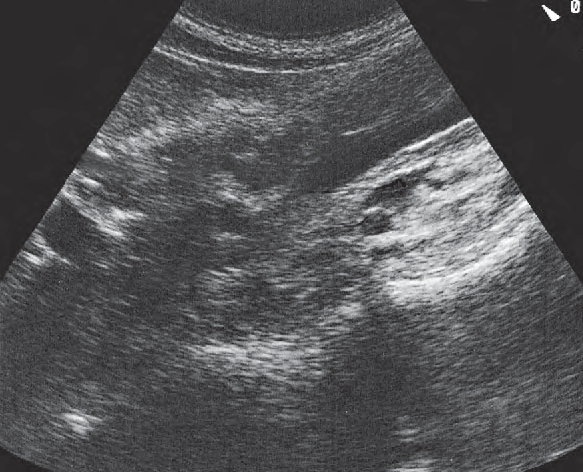 Left renal vein ultrasound image, Right renal artery and left renal vein