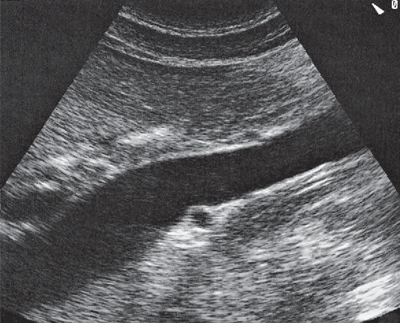 Right renal artery ultrasound image, Vena cava and right renal artery