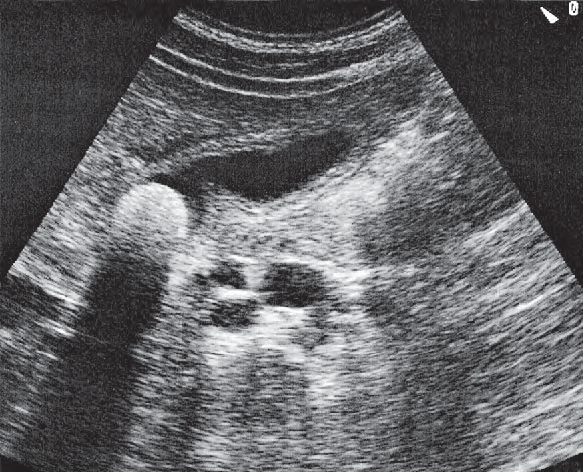 Right Renal Vein Ultrasound Anatomy