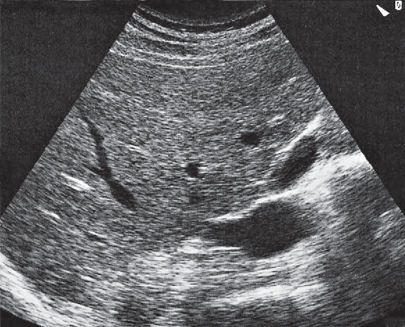 Duodenum ultrasound image, Opening of renal vein