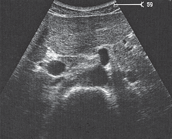 Quadrate lobe ultrasound image, Celiac trunk
