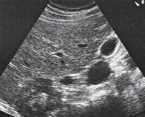 Right Kidney Ultrasound Anatomy