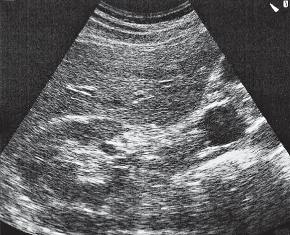 Duodenum ultrasound image, Renal vein at hilum, renal artery